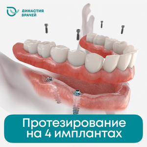 Протезирование на 4 имплантах (импланты+установка)