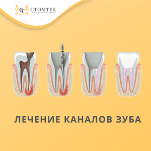Лечение корневых каналов
