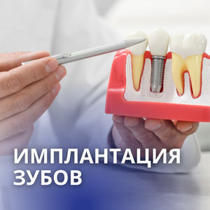 Имплантация зубов