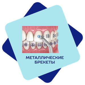 Металлические брекеты 