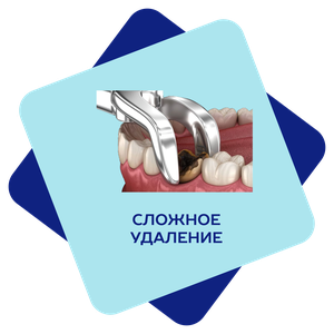 Сложное удаление зуба 