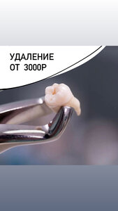 Удаление зуба