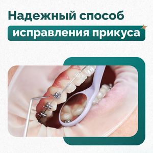 Установка брекет-систем