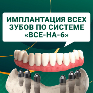 Имплантация всех зубов по системе «Все на 6»
