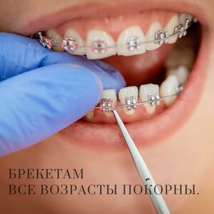 Установка самолигирующей металлической брекет-системы Н-