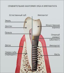 Имплантация