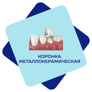 Коронка металлокерамическая 