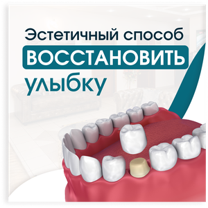 Установка виниров