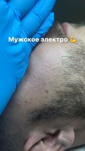 Мужская электроэпиляция