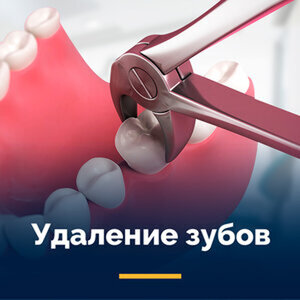 Удаление зубов