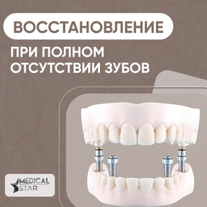 Имплантация All-on-4/6