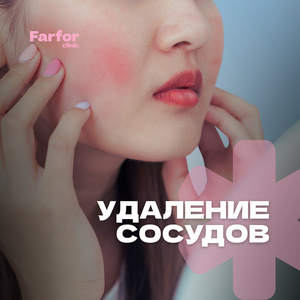 Лазерное удаление сосудов