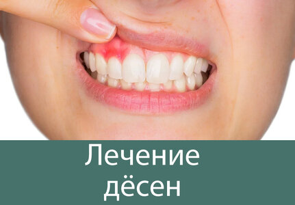 Лечение дёсен
