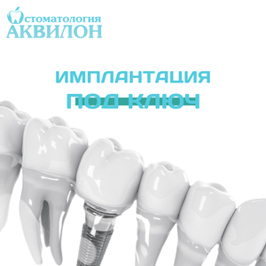 Имплантация под ключ!