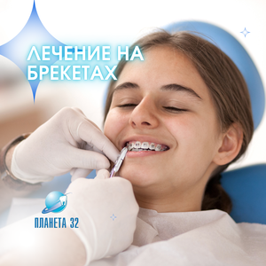 Лечение на брекет-системе (1 челюсть)