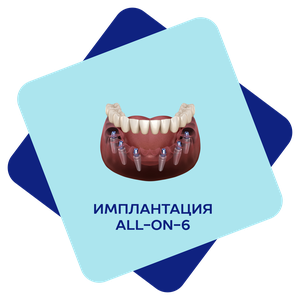 Имплантация ALL-ON-6
