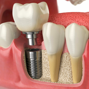 Имплантация Dentium