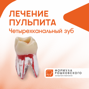 Лечение пульпита четырехканальный зуб