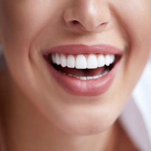 Установка виниров в Туле. Стоматология "SuperDenta"