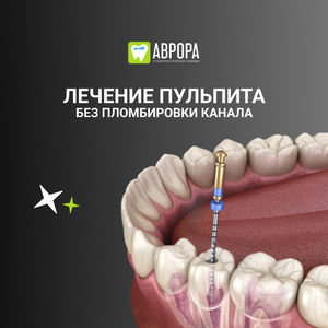 Лечение пульпита без пломбировки канала (1 канал)