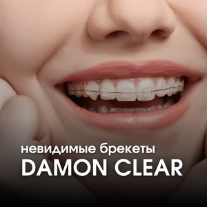 Невидимые брекеты Damon Clear