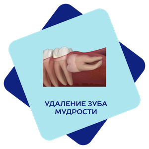 Удаление зуба мудрости 
