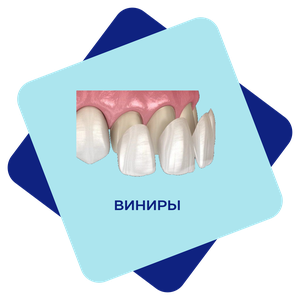 Виниры