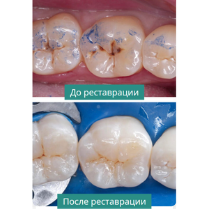 Художественная реставрация зубов