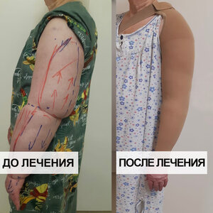 Хирургия лимфедемы
