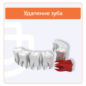 Удаление зуба