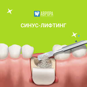 Синус-лифтинг закрытый 