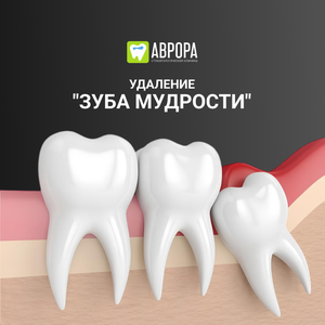 Удаление "зуба мудрости" 