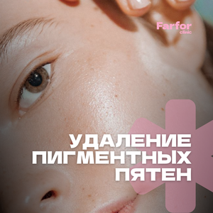 Удаление пигментных пятен 
