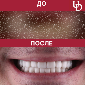 Выравнивание зубов без брекетов. Сканирование в подарок!