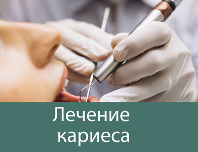 Лечение кариеса