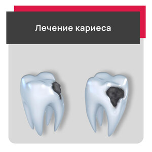 Лечение кариеса 