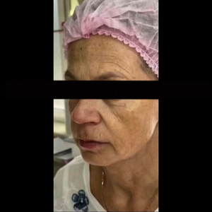 Full Face безоперационная подтяжка. Комплекс омоложения
