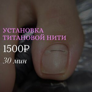 Установка титановой нити (педикюр)
