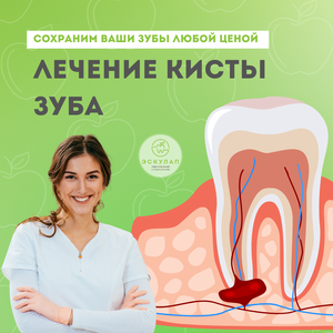 Лечение кисты зуба