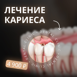 Лечение кариеса