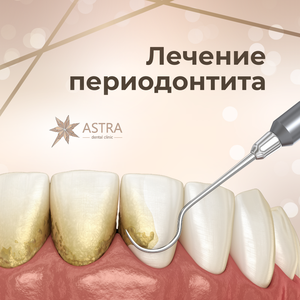 Первичное эндодонтическое лечение премоляра