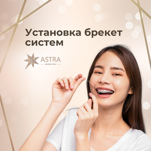 Установка металлической безлигатурной брекет системы