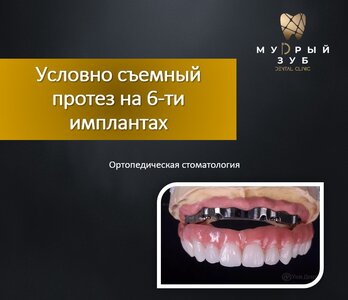Условно съемный протез на 6-ти имплантах