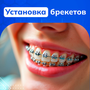 Классические металлические брекеты (1 челюсть)