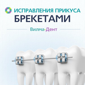 Брекеты