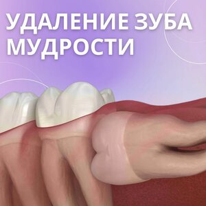 Удаление зуба мудрости от
