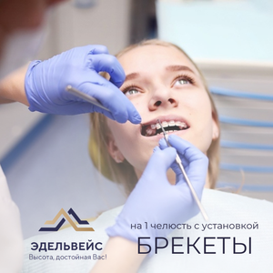 Брекеты на 1 челюсть с установкой