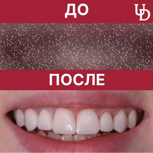Цельноциркониевая коронка со скидкой 25%