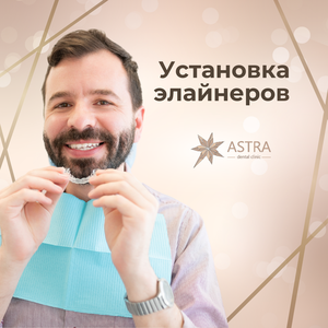 Установка элайнеров