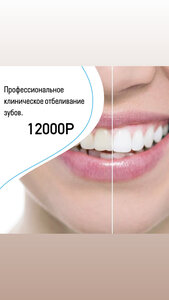 Клиническое отбеливание